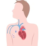 Central Catheterization in Punawale near Tathawade