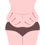 Liposuction surgery by best general surgeon in Pune