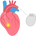 Pacemaker operation in Wakad, Ravet, Pimpri Chinchwad