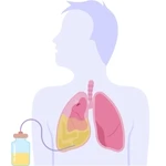 Plural & Pericardial Tapping in Punawale near Tathawade