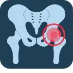 Hip joint replacement