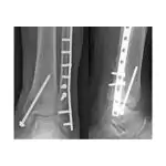 Internal fixation of fractures