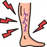 Swollen Veins - Symptom of Varicose Veins