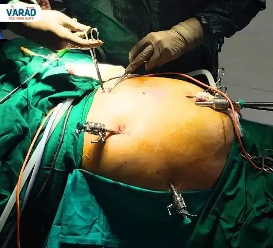 Live Laparoscopic Surgery by Dr. Vinayak Kshirsagar