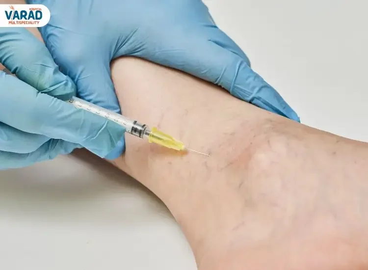 Cost of Injection Treatment for Varicose Veins in Pune Cost of Injection Treatment for Varicose Veins in Pune