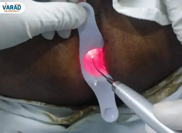 Laser Piles Surgery in Pune at Varad Multispeciality Hospital, Punawale Laser Piles Surgery in Pune at Varad Multispeciality Hospital, Punawale