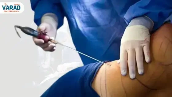 Liposuction Treatment for Lipoma Removal in Pune & PCMC