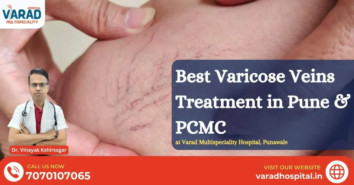 Varicose Veins Treatment in Pune & PCMC