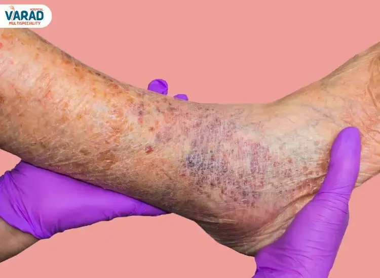 Varicose Veins treatment cost in Pune Varicose Veins treatment cost in Pune