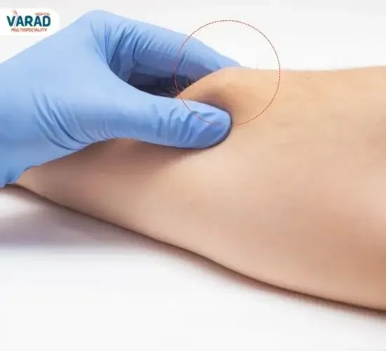What are Lipomas Explained by Dr. Vinayak Kshirsagar